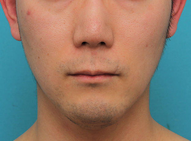 鼻の下を短く（上口唇短縮手術、上口唇リフト、リップリフト、人中短縮術）,リップリフト(人中短縮手術)を行った30代男性の症例写真,手術前,mainpic_hanashita004a.jpg