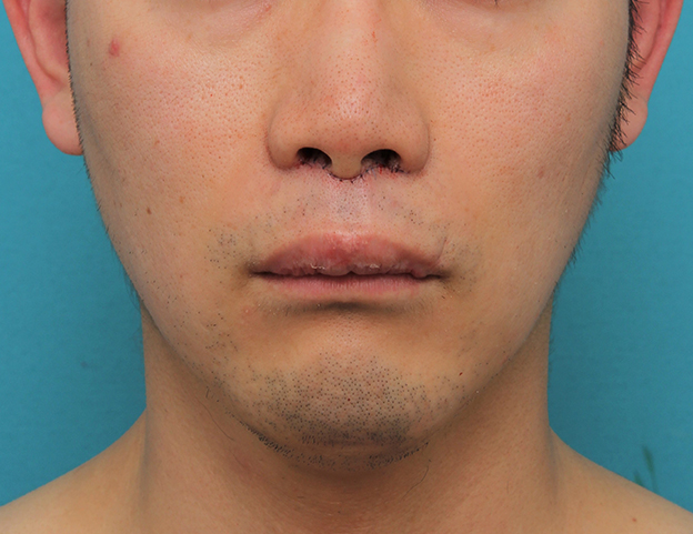 鼻の下を短く（上口唇短縮手術、上口唇リフト、リップリフト、人中短縮術）,リップリフト(人中短縮手術)を行った30代男性の症例写真,手術直後,mainpic_hanashita004b.jpg
