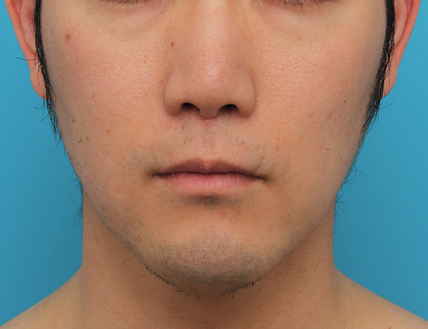 鼻の下を短く（上口唇短縮手術、上口唇リフト、リップリフト、人中短縮術）,リップリフト(人中短縮手術)を行った30代男性の症例写真,3週間後,mainpic_hanashita004d.jpg