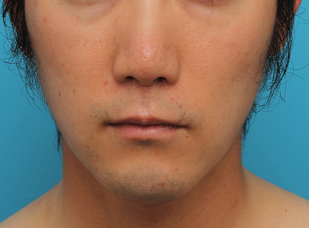 鼻の下を短く（上口唇短縮手術、上口唇リフト、リップリフト、人中短縮術）,リップリフト(人中短縮手術)を行った30代男性の症例写真,2ヶ月後,mainpic_hanashita004e.jpg