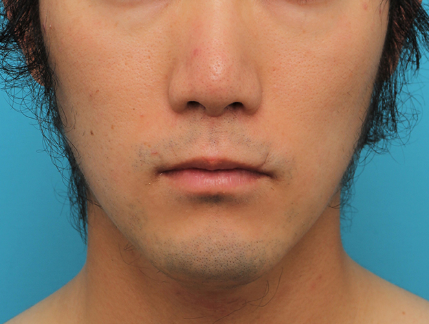 鼻の下を短く（上口唇短縮手術、上口唇リフト、リップリフト、人中短縮術）,リップリフト(人中短縮手術)を行った30代男性の症例写真,6ヶ月後,mainpic_hanashita004f.jpg