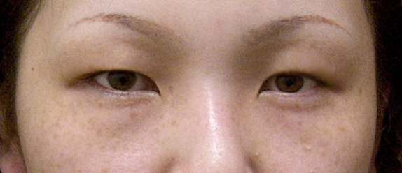症例写真,二重まぶた・埋没法の症例 一重のため表情が暗く見えていた30代女性,Before,ba_maibotsu13_b.jpg