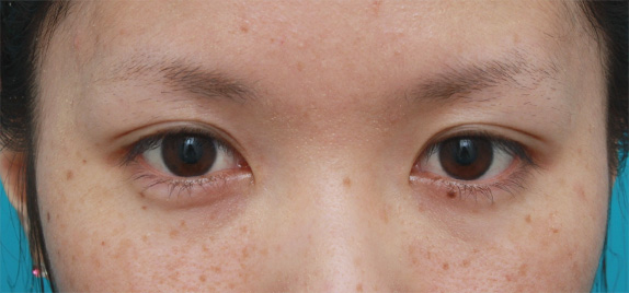 目の左右差を両目の埋没法で修正した症例写真,After（メイクなし）,ba_maibotsu32_a01.jpg
