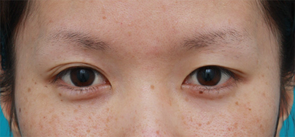 目の左右差を両目の埋没法で修正した症例写真,Before,ba_maibotsu32_b.jpg