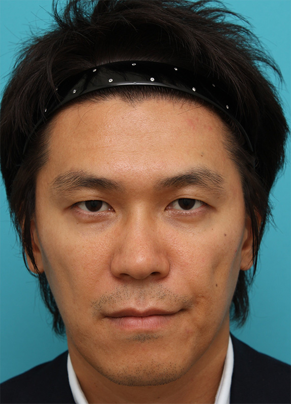 30代男性に行った二重まぶた埋没法と鼻のヒアルロン酸注射症例写真,Before,ba_maibotsu34_b.jpg