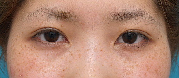 二重まぶた・ミニ切開法（部分切開）の症例 術後1ヶ月、目もとがくっきりした20代女性,After（メイクなし）,ba_minisekkai13_a01.jpg