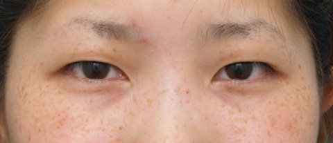 症例写真,二重まぶた・ミニ切開法（部分切開）の症例 術後1ヶ月、目もとがくっきりした20代女性,手術前,mainpic_mini_sekkai06a.jpg