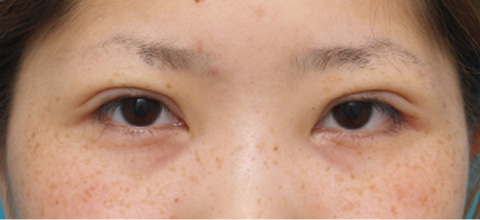 症例写真,二重まぶた・ミニ切開法（部分切開）の症例 術後1ヶ月、目もとがくっきりした20代女性,手術直後,mainpic_mini_sekkai06b.jpg