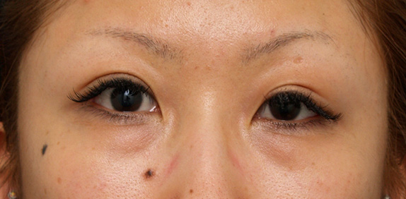 二重まぶた・ミニ切開法（部分切開）,眼瞼下垂（がんけんかすい）,片目の先天性眼瞼下垂に対する手術の症例写真,After,ba_minisekkai20_a01.jpg