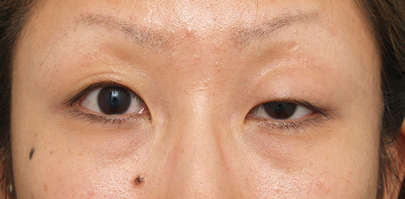 二重まぶた・ミニ切開法（部分切開）,眼瞼下垂（がんけんかすい）,片目の先天性眼瞼下垂に対する手術の症例写真,Before,ba_minisekkai20_b.jpg