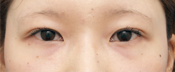 症例写真,二重まぶた・全切開法の症例 施術後1ヶ月の20代女性,After（1ヶ月後）,ba_sekkai10_b.jpg