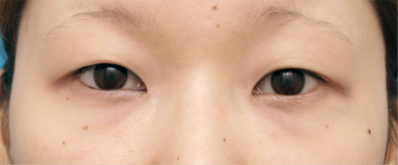 症例写真,二重まぶた・全切開法の症例 施術後1ヶ月の20代女性,Before,ba_sekkai10_b.jpg