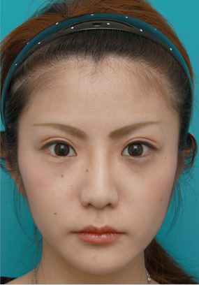 症例写真,ミニ切開二重+目頭切開+鼻プロテーゼ+鼻尖形成+鼻翼縮小症例写真,After（メイクあり）,