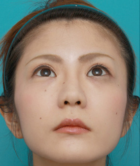隆鼻術（シリコンプロテーゼ）,ミニ切開二重+目頭切開+鼻プロテーゼ+鼻尖形成+鼻翼縮小症例写真,After（メイクあり）,