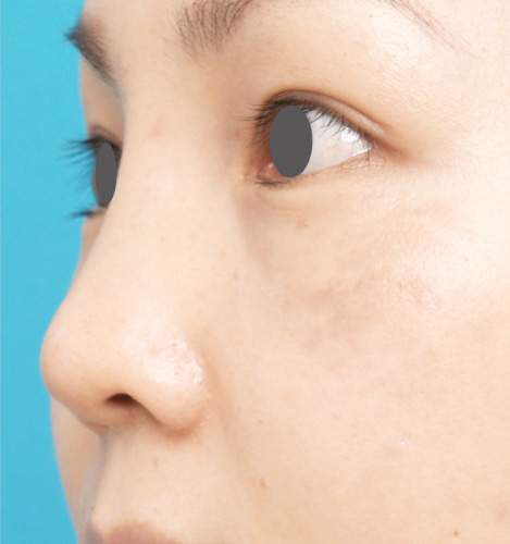 隆鼻術（シリコンプロテーゼ）,隆鼻術（シリコンプロテーゼ）の症例 鼻が低いことがコンプレックスだった30代女性,After,ba_ryubi15_b.jpg