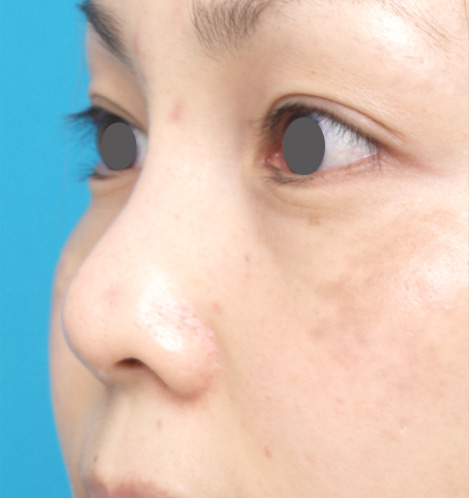 隆鼻術（シリコンプロテーゼ）,隆鼻術（シリコンプロテーゼ）の症例 鼻が低いことがコンプレックスだった30代女性,Before,ba_ryubi15_b.jpg