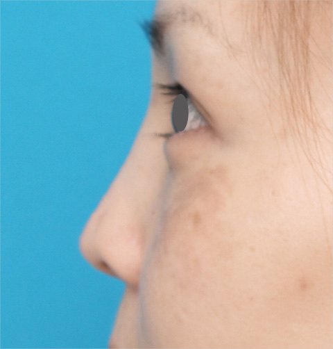 隆鼻術（シリコンプロテーゼ）,隆鼻術（シリコンプロテーゼ）の症例 鼻が低いことがコンプレックスだった30代女性,After,ba_ryubi19_b.jpg