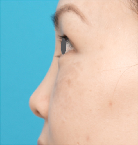 隆鼻術（シリコンプロテーゼ）,隆鼻術（シリコンプロテーゼ）の症例 鼻が低いことがコンプレックスだった30代女性,Before,ba_ryubi19_b.jpg