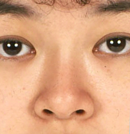 隆鼻術（シリコンプロテーゼ）,隆鼻術（シリコンプロテーゼ）の症例 鼻が低いため顔が平べったい印象だった20代女性,After,ba_ryubi21_a01.jpg