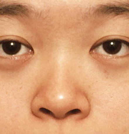 隆鼻術（シリコンプロテーゼ）の症例 鼻が低いため顔が平べったい印象だった20代女性,Before,ba_ryubi21_b.jpg