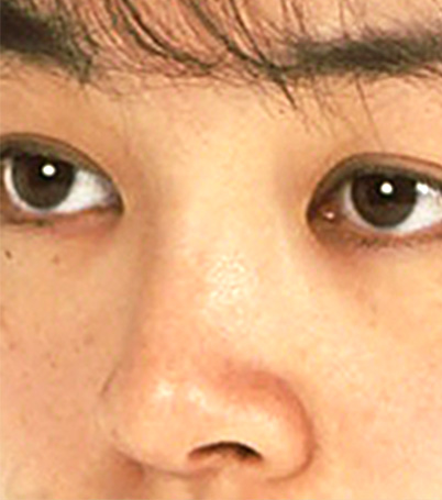 隆鼻術（シリコンプロテーゼ）,隆鼻術（シリコンプロテーゼ）の症例 鼻が低いため顔が平べったい印象だった20代女性,After,ba_ryubi22_b.jpg