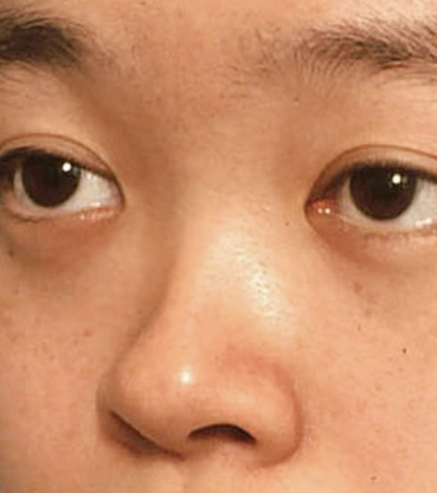 隆鼻術（シリコンプロテーゼ）,隆鼻術（シリコンプロテーゼ）の症例 鼻が低いため顔が平べったい印象だった20代女性,Before,ba_ryubi22_b.jpg