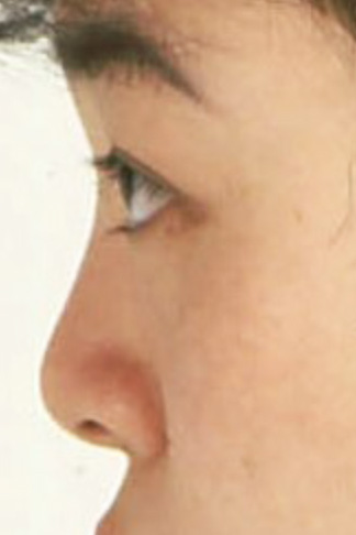 隆鼻術（シリコンプロテーゼ）,隆鼻術（シリコンプロテーゼ）の症例 鼻が低いため顔が平べったい印象だった20代女性,After,ba_ryubi23_b.jpg