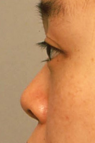 隆鼻術（シリコンプロテーゼ）,隆鼻術（シリコンプロテーゼ）の症例 鼻が低いため顔が平べったい印象だった20代女性,Before,ba_ryubi23_b.jpg