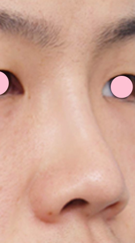 隆鼻術（シリコンプロテーゼ）の症例 鼻筋が通っていない貧弱さが悩みの20代男性,After（1週間後）,ba_ryubi16_a01.jpg