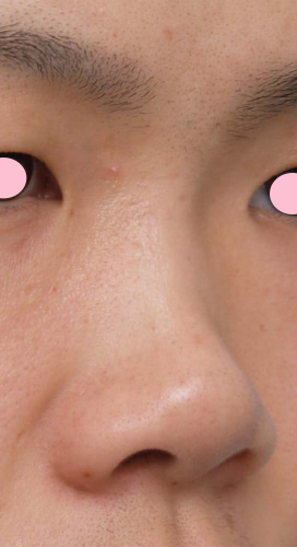 隆鼻術（シリコンプロテーゼ）,隆鼻術（シリコンプロテーゼ）の症例 鼻筋が通っていない貧弱さが悩みの20代男性,Before,ba_ryubi16_b.jpg