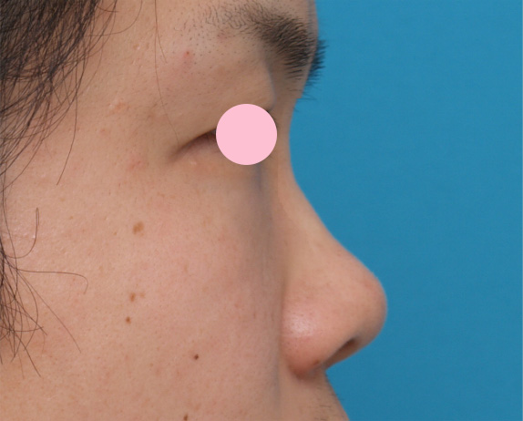 隆鼻術（シリコンプロテーゼ）,隆鼻術（シリコンプロテーゼ）の症例 鼻筋が通っていない貧弱さが悩みの20代男性,Before,ba_ryubi18_b.jpg