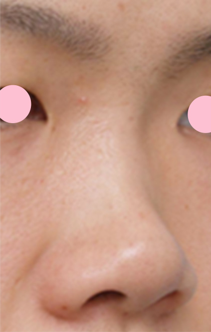 症例写真,隆鼻術（シリコンプロテーゼ）の症例 鼻筋が通っていない貧弱さが悩みの20代男性,手術前,mainpic_ryubi3a.jpg
