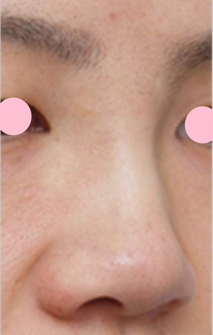 症例写真,隆鼻術（シリコンプロテーゼ）の症例 鼻筋が通っていない貧弱さが悩みの20代男性,手術直後,mainpic_ryubi3b.jpg