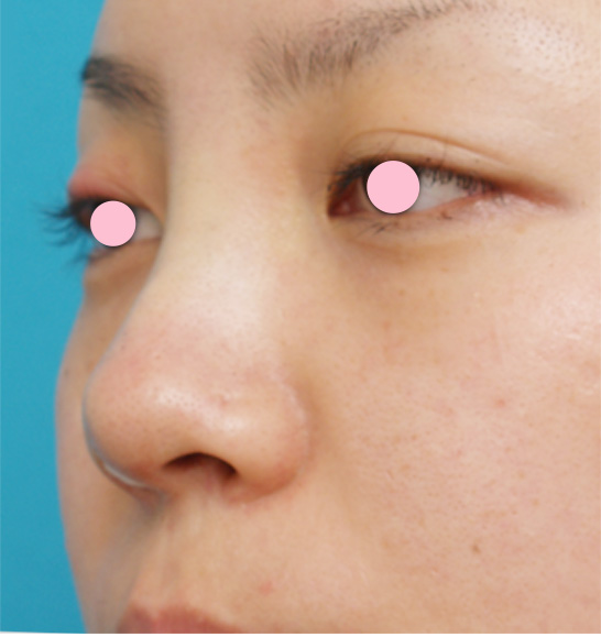 隆鼻術（シリコンプロテーゼ）,隆鼻術（シリコンプロテーゼ）の症例 鼻先が上に向いたブタ鼻のように見えていた20代女性,手術直後,mainpic_ryubi04b.jpg