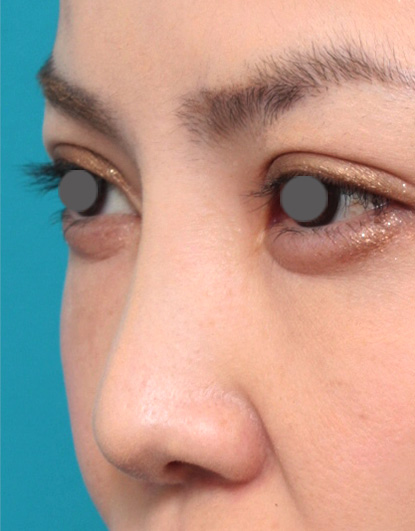 隆鼻術（シリコンプロテーゼ）,他院で受けた鼻の手術の修正症例写真,After,ba_ryubi31_b.jpg