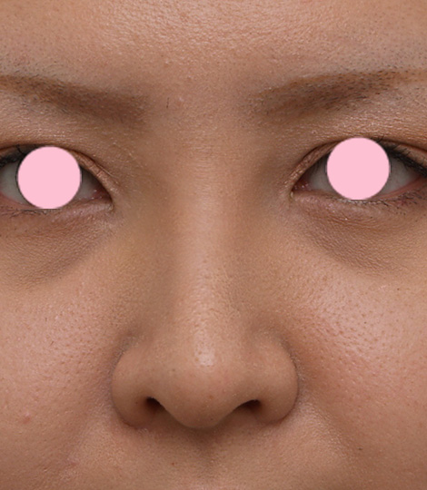隆鼻術（シリコンプロテーゼ）,3mmの鼻シリコンプロテーゼを入れた症例写真,After（1週間後）,ba_ryubi32_b.jpg