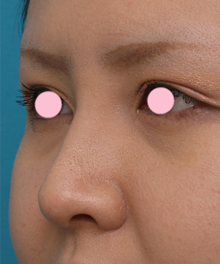 隆鼻術（シリコンプロテーゼ）,3mmの鼻シリコンプロテーゼを入れた症例写真,After（1週間後）,ba_ryubi33_b.jpg