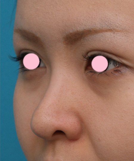 隆鼻術（シリコンプロテーゼ）,3mmの鼻シリコンプロテーゼを入れた症例写真,Before,ba_ryubi33_b.jpg