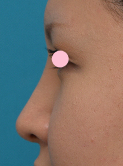 隆鼻術（シリコンプロテーゼ）,3mmの鼻シリコンプロテーゼを入れた症例写真,After（1週間後）,ba_ryubi34_b.jpg