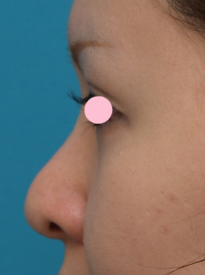 隆鼻術（シリコンプロテーゼ）,3mmの鼻シリコンプロテーゼを入れた症例写真,Before,ba_ryubi34_b.jpg