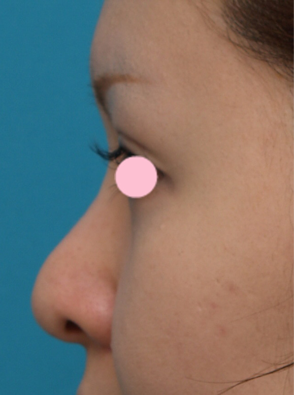 隆鼻術（シリコンプロテーゼ）,3mmの鼻シリコンプロテーゼを入れた症例写真,手術前,mainpic_ryubi10a.jpg
