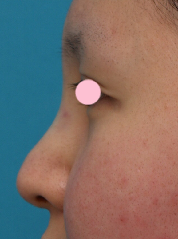 隆鼻術（シリコンプロテーゼ）,3mmの鼻シリコンプロテーゼを入れた症例写真,手術直後,mainpic_ryubi10b.jpg