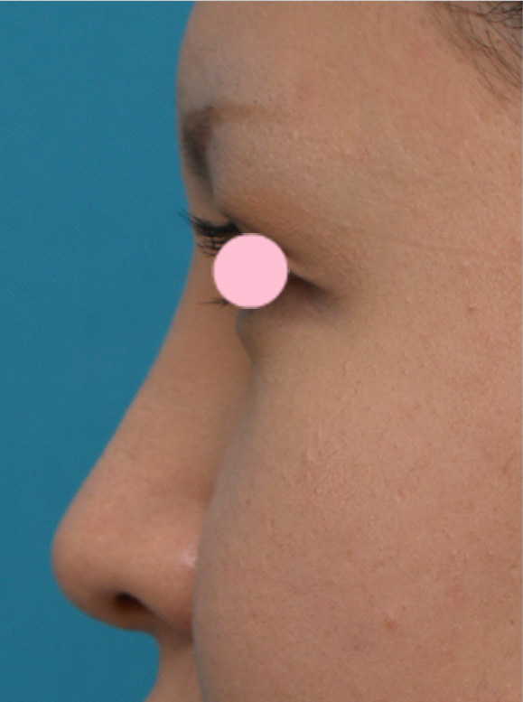 隆鼻術（シリコンプロテーゼ）,3mmの鼻シリコンプロテーゼを入れた症例写真,1週間後,mainpic_ryubi10c.jpg