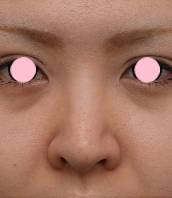 隆鼻術（シリコンプロテーゼ）,3mmの鼻シリコンプロテーゼを入れた症例写真,手術前,mainpic_ryubi8a.jpg