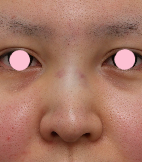 隆鼻術（シリコンプロテーゼ）,3mmの鼻シリコンプロテーゼを入れた症例写真,手術直後,mainpic_ryubi8b.jpg