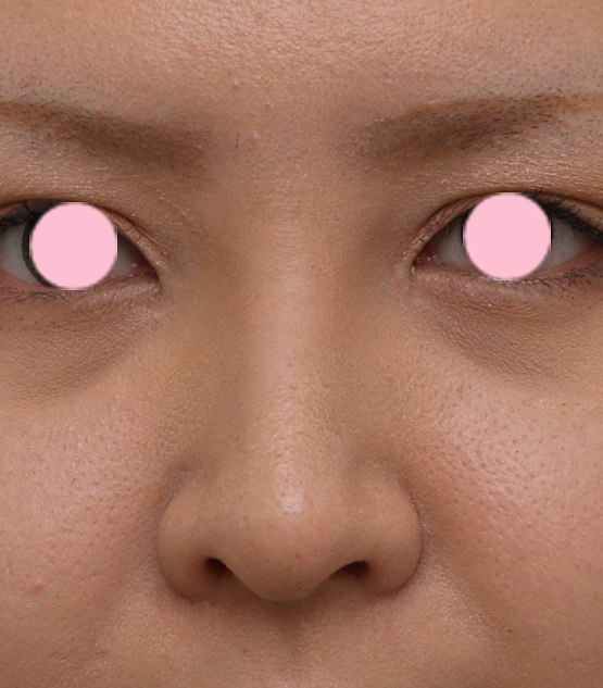 隆鼻術（シリコンプロテーゼ）,3mmの鼻シリコンプロテーゼを入れた症例写真,1週間後,mainpic_ryubi8c.jpg