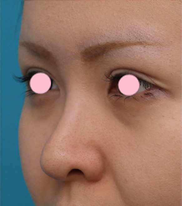 隆鼻術（シリコンプロテーゼ）,3mmの鼻シリコンプロテーゼを入れた症例写真,手術前,mainpic_ryubi9a.jpg