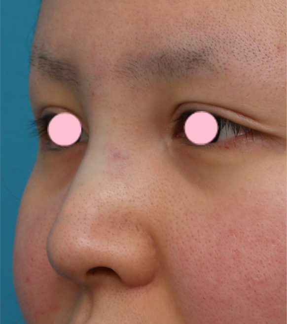 隆鼻術（シリコンプロテーゼ）,3mmの鼻シリコンプロテーゼを入れた症例写真,手術直後,mainpic_ryubi9b.jpg