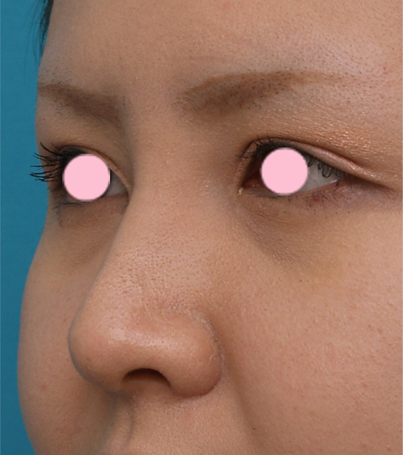 隆鼻術（シリコンプロテーゼ）,3mmの鼻シリコンプロテーゼを入れた症例写真,1週間後,mainpic_ryubi9c.jpg