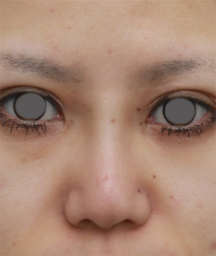 隆鼻術（シリコンプロテーゼ）,鼻のシリコンプロテーゼ抜き（除去）,他院で受けた手術の修正（鼻）,他院で入れたL型プロテーゼをI型プロテーゼに入れ替えて修正した症例写真,After（2ヶ月後）,ba_ryubi37_a01.jpg